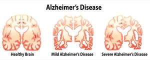 brain-degeneration-in-alzheimer-disease