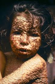 This child is showing symptoms of smallpox